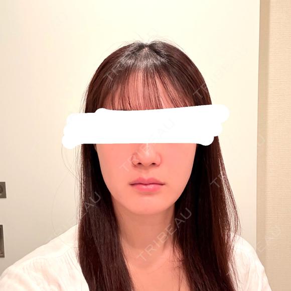 その他（輪郭） / ボトックス（エラ・小顔） 大美会クリニック 心斎橋本院 BEFORE メイン用