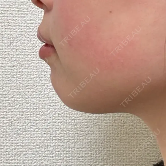 ボトックス（あご） / ヒアルロン酸注入（あご） / ボトックス（エラ・小顔） Next Tokyo Clinic BEFORE メイン用