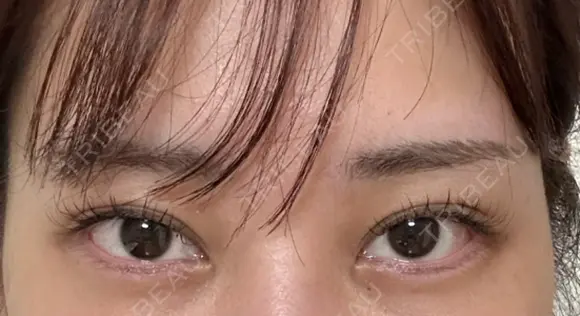 その他（目元） eクリニック 横浜みなとみらい院 BEFORE メイン用