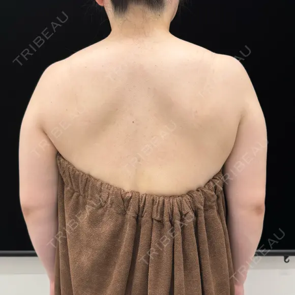 脂肪吸引（二の腕） EMMA CLINIC（エマクリニック） BEFORE メイン用