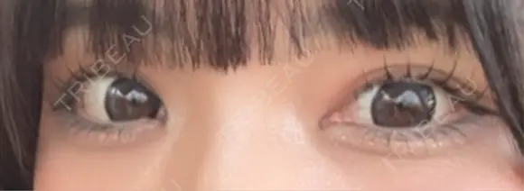 ヒアルロン酸注入（涙袋） プライベートスキンクリニック 梅田本院 BEFORE メイン用