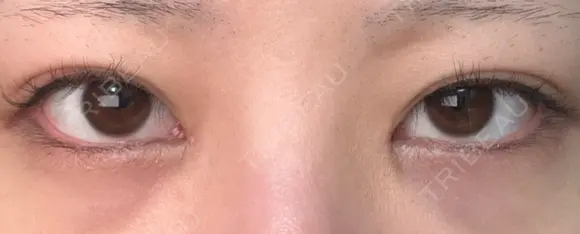 ヒアルロン酸注入（涙袋） 吉祥寺アイビークリニック BEFORE メイン用