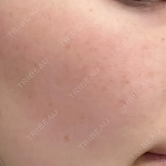 ルメッカ 大美会クリニック 京都烏丸院 BEFORE メイン用