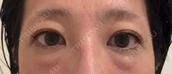 下まぶたの脂肪取り / 脂肪注入（目の下） eクリニック 福岡院 BEFORE メイン用