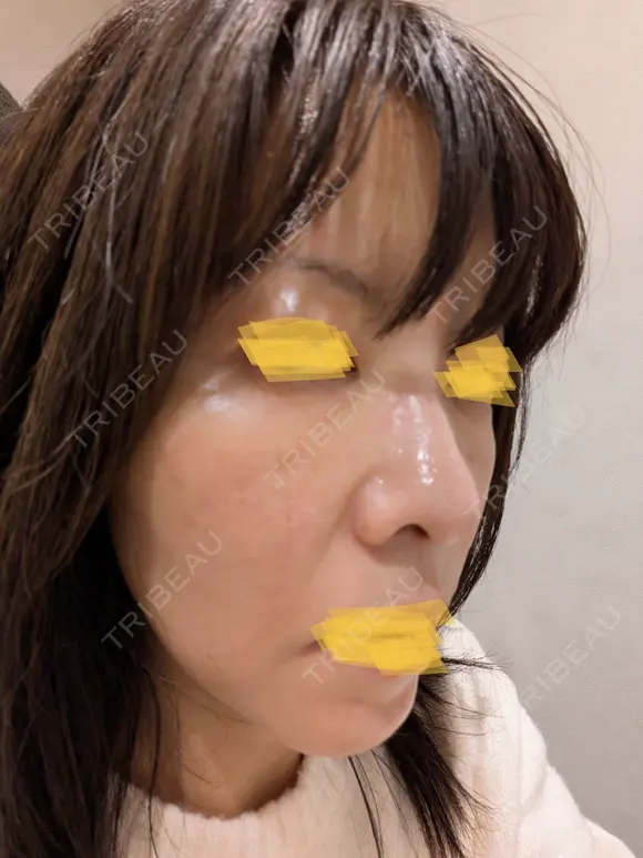 毛穴洗浄（ハイドラフェイシャルなど） Zetith Beauty Clinic 池袋院 BEFORE メイン用