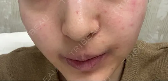 ルメッカ 大美会クリニック 京都烏丸院 BEFORE メイン用