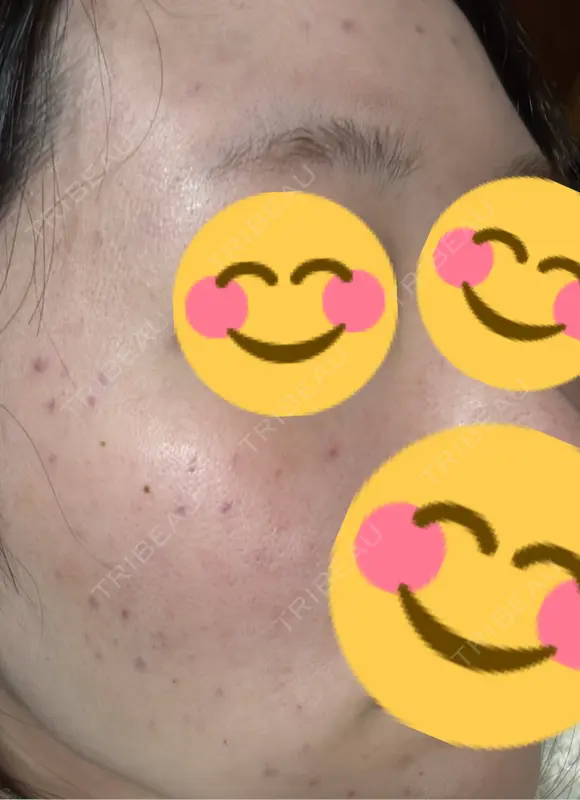 肌育注射（ジュベルックなど） 大美会クリニック 京都烏丸院 BEFORE メイン用