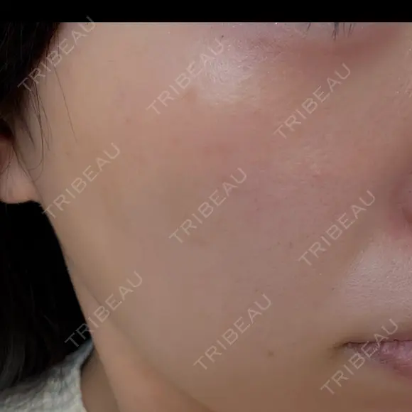 ピーリング（ハリ・ツヤ） / ルメッカ 大美会クリニック 梅田院 BEFORE メイン用