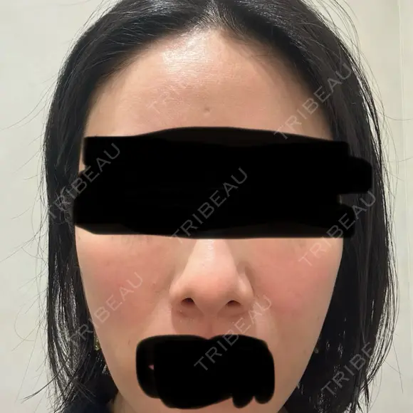 ジャルプロ ウィルビークリニック 新宿院 BEFORE メイン用