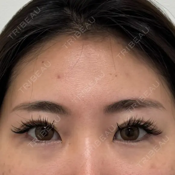 二重埋没 / 目頭切開 / 目尻切開 / タレ目形成・グラマラスライン（切開） / 目尻靭帯移動 BITO BEAUTY CLINIC BEFORE メイン用