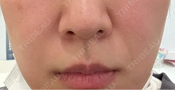 鼻翼基部形成（貴族手術） / ヒアルロン酸注入（鼻翼基部） ルラ美容クリニック 福岡天神院 BEFORE メイン用