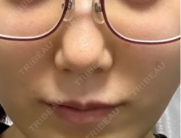 ポテンツァ エトワールレジーナクリニック新宿院 BEFORE メイン用