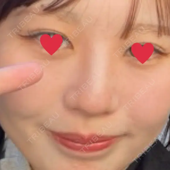 ピコレーザートーニング（美白・肝斑） 東京美容皮膚科アロエクリニック池袋 BEFORE メイン用