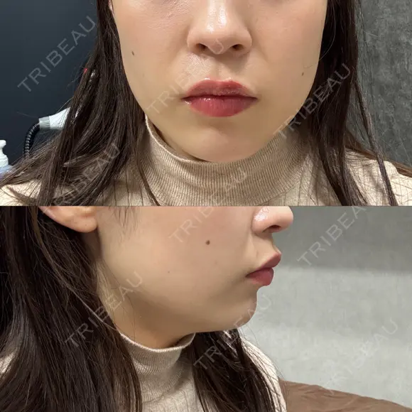 ボトックス（エラ・小顔） BiBiクリニック BEFORE メイン用