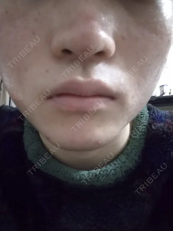 イオン導入 / ピーリング（ハリ・ツヤ） / ルメッカ ルラ美容クリニック 札幌本院 BEFORE メイン用