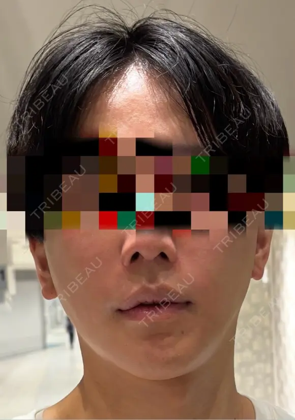 糸リフト / 脂肪吸引（顔） / 脂肪注入（額） / ボトックス（エラ・小顔） / ボトックス（口角） / 脂肪注入（輪郭） / その他（輪郭） 4Dクリニック BEFORE メイン用