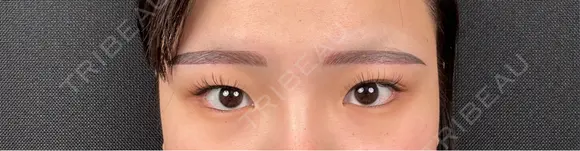 二重埋没 / 目頭切開 東京シンデレラ美容外科 池袋院 BEFORE メイン用