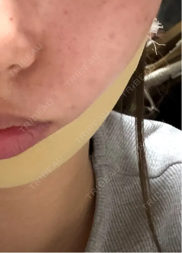 糸リフト / 脂肪吸引（顔） / 水光注射（ハリ・美肌） Wing clinic 豊中駅前院 BEFORE メイン用