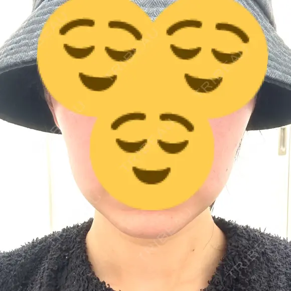 オンダリフト ルラ美容クリニック 名古屋本院 BEFORE メイン用