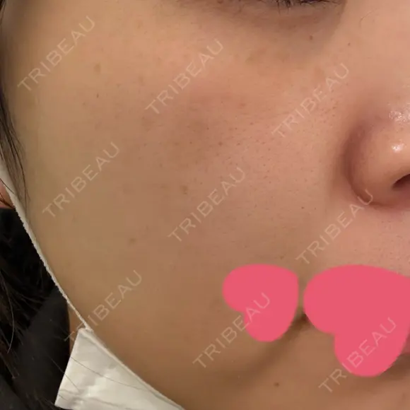 イオン導入 / 医療脱毛（顔） / ピーリング（ハリ・ツヤ） / ルメッカ ルラ美容クリニック 広島院 BEFORE メイン用