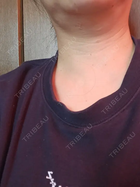 ハイフ（首） アクティブエイジクリニック BEFORE メイン用