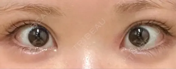 タレ目形成・グラマラスライン（切開） 形成外科と美容外科のクリニック池袋 BEFORE メイン用