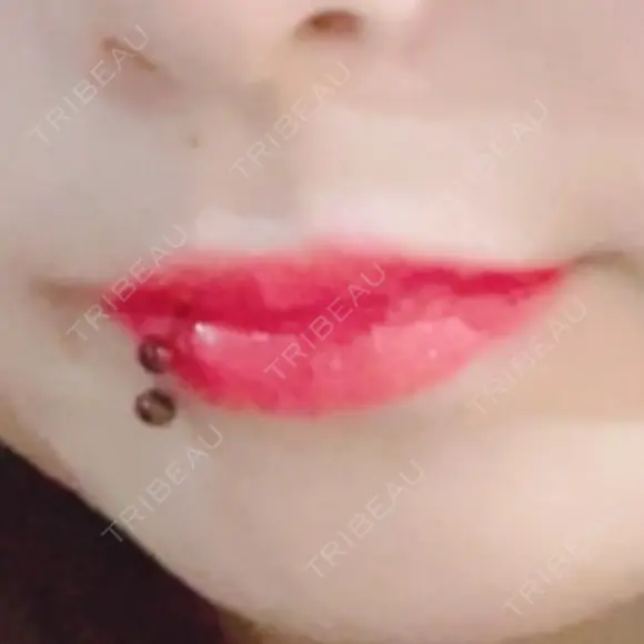 ヒアルロン酸注入（涙袋） / ヒアルロン酸注入（あご） / ヒアルロン酸注入（唇） Next Tokyo Clinic BEFORE メイン用