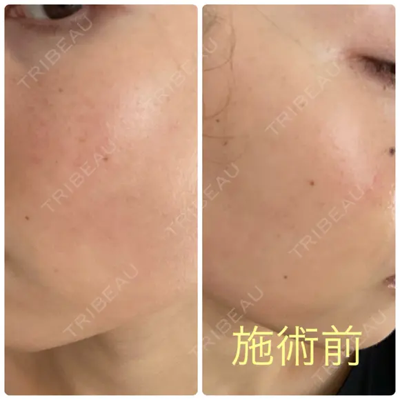 ピーリング（ニキビ・毛穴） / イオン導入 / ルメッカ ルラ美容クリニック 札幌本院 BEFORE メイン用