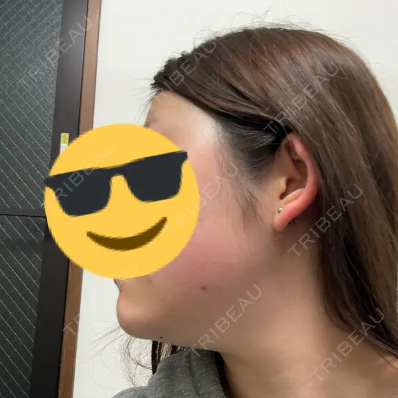 インモード 東京シルククリニック 新宿院 BEFORE メイン用