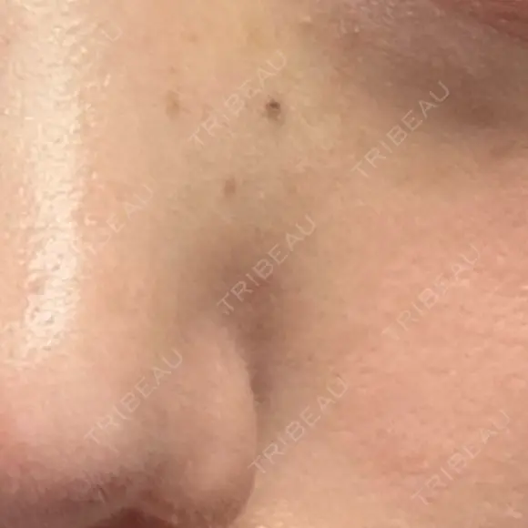 ほくろ・いぼ除去レーザー（肌） 心斎橋KT美容クリニック BEFORE メイン用