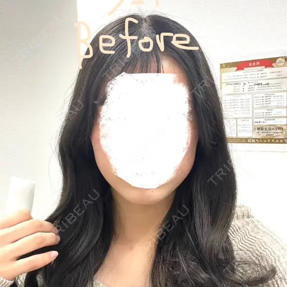 ボトックス（エラ・小顔） 東京美容皮膚科アロエクリニック池袋 BEFORE メイン用