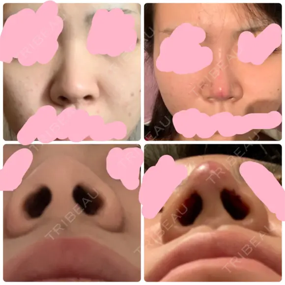 隆鼻術 / ヒアルロン酸注入（鼻） 東京ヒルズクリニック 新宿院 BEFORE メイン用