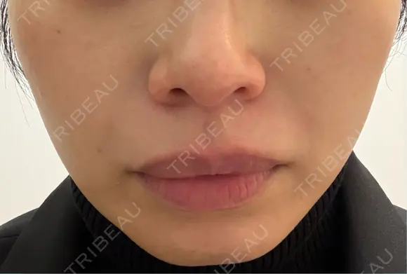 ピーリング（ニキビ・毛穴） Clara CLINIC 美容皮膚科・歯科 BEFORE メイン用