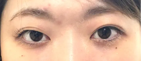 二重切開 EMMA CLINIC（エマクリニック） BEFORE メイン用