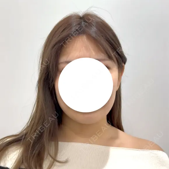 脂肪吸引（顔） HAAB BEAUTY CLINIC 南青山本院（新院） BEFORE メイン用