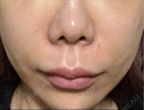 脂肪溶解注射（顔） ルラ美容クリニック 岡山院 BEFORE メイン用