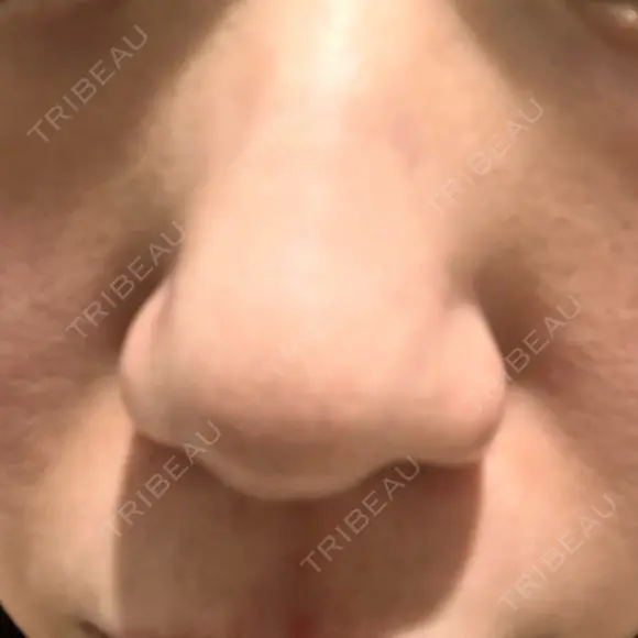 キュアジェット レナータクリニック 立川院 BEFORE メイン用