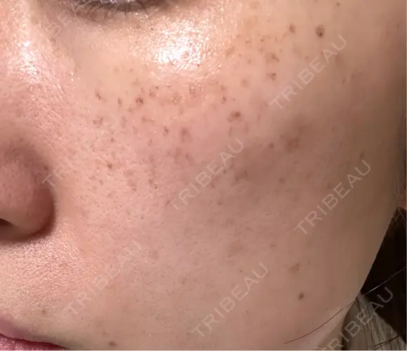 イオン導入 / ピーリング（ハリ・ツヤ） / ルメッカ ルラ美容クリニック 福岡本院 BEFORE メイン用