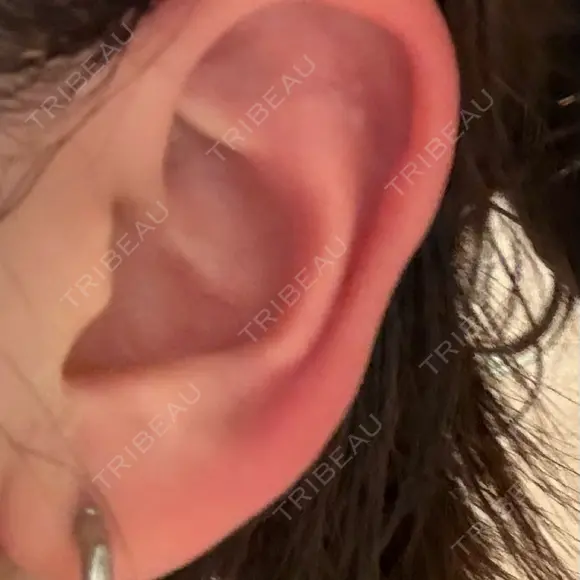 ピアス穴あけ 渋谷美容外科クリニック 新橋院 BEFORE メイン用