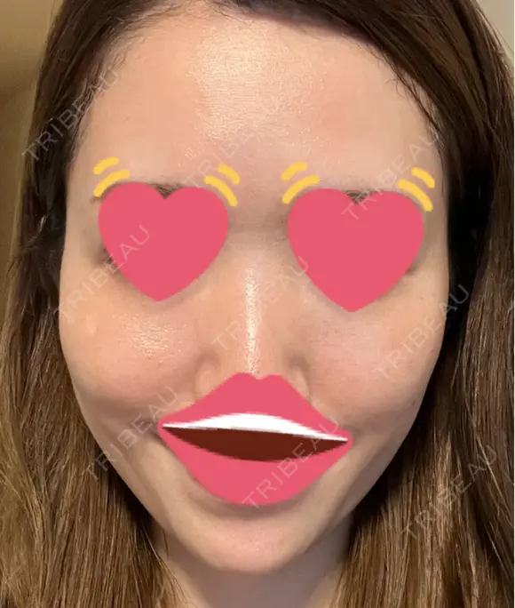 脂肪注入（肌） 日本ウェルネス再生クリニック BEFORE メイン用