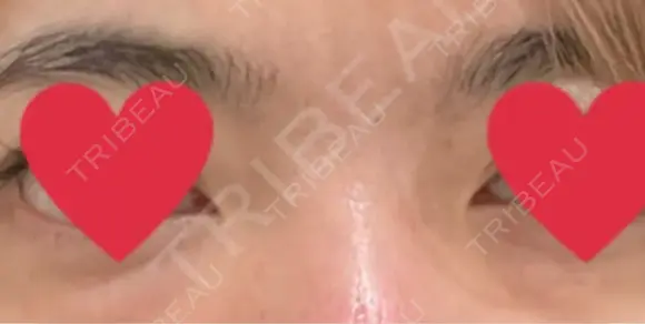 クマ治療 KIMI CLINIC 形成・美容外科 BEFORE メイン用