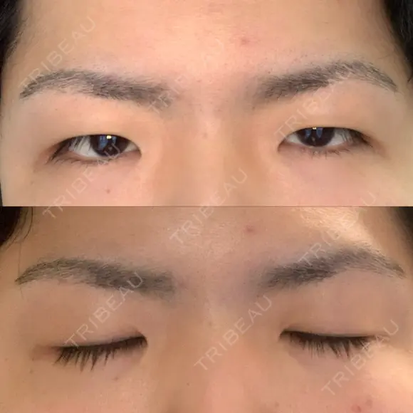 眼瞼下垂（切開） 札幌中央形成外科 BEFORE メイン用