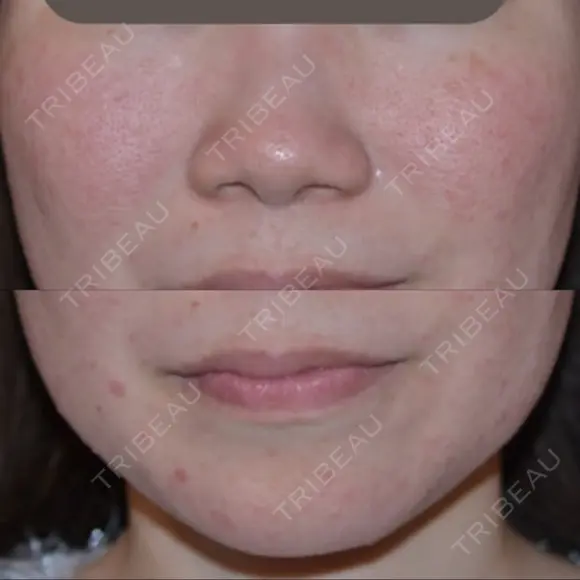 ピーリング（ニキビ・毛穴） / 美肌レーザー NEO Skin Clinic恵比寿 BEFORE メイン用