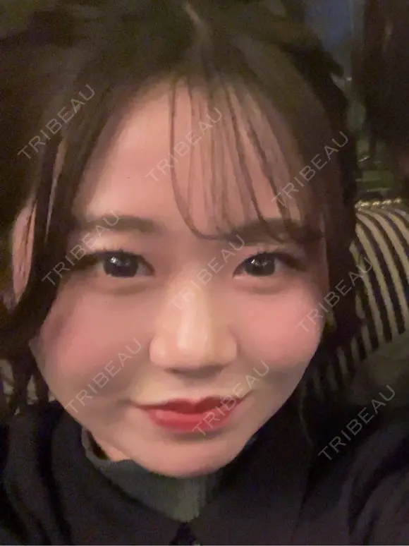 二重埋没 大塚美容形成外科 銀座本院 BEFORE メイン用