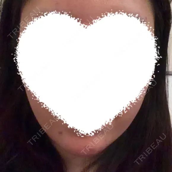 ヒアルロン酸注入（あご） Next Tokyo Clinic BEFORE メイン用