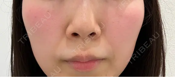 鼻尖形成（切開） / 鼻中隔延長（切開） / 軟骨移植 / 眉間プロテーゼ eクリニック 福岡院 BEFORE メイン用