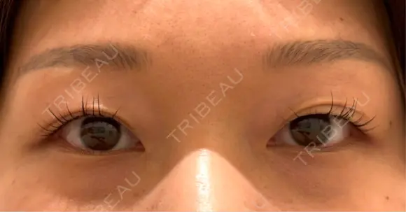 二重埋没 オジスキンクリニック BEFORE メイン用