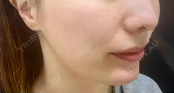 鼻翼基部形成（貴族手術） eクリニック 富山駅前院 BEFORE メイン用