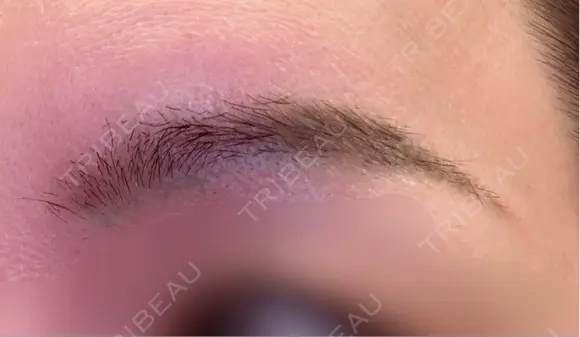 アートメイク除去・修正 東京イセアクリニック BEFORE メイン用