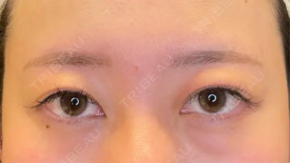 脂肪吸引（顔） / 目尻切開 / タレ目形成・グラマラスライン（埋没） LOUIS CLINIC 二子玉川院【ルイクリニック】 BEFORE メイン用